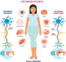 Ilustração do sistema nervoso central com áreas afetadas pela EM